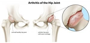 Arthritis of the hip joint